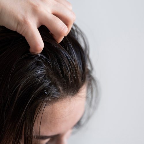 Dermatite, caspa e psoríase: como proteger a pele das armadilhas do inverno