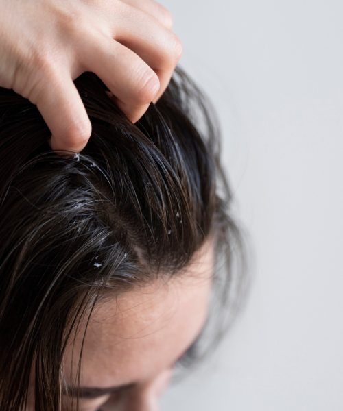 Dermatite, caspa e psoríase: como proteger a pele das armadilhas do inverno