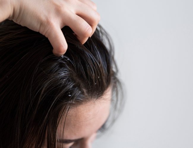 Dermatite, caspa e psoríase: como proteger a pele das armadilhas do inverno