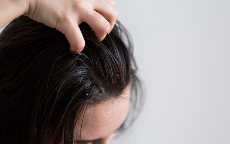 Dermatite, caspa e psoríase: como proteger a pele das armadilhas do inverno
