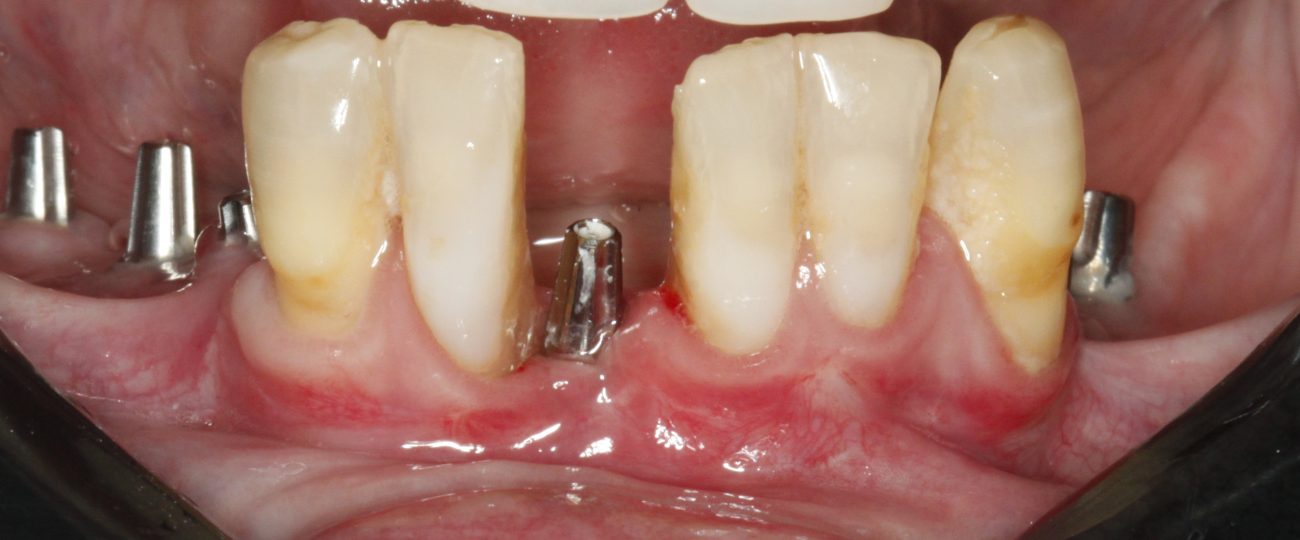 O que o tempo faz com quem perde os dentes