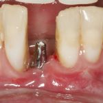 O que o tempo faz com quem perde os dentes