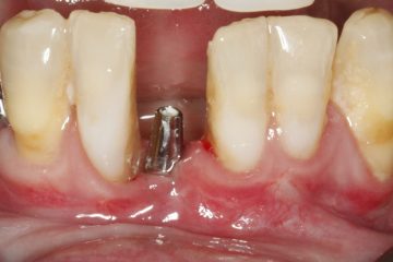 O que o tempo faz com quem perde os dentes