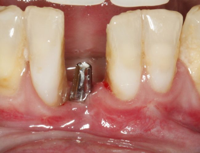 O que o tempo faz com quem perde os dentes
